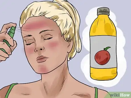 Image titled Prevent Skin Peeling After Sunburn Step 8