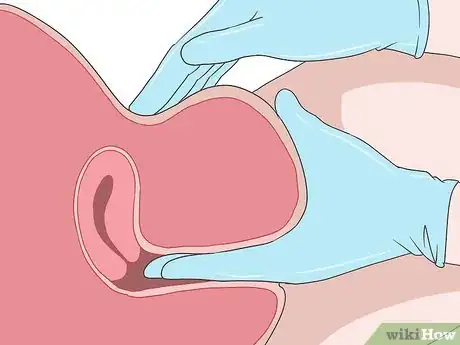 Image titled Do a Pap Smear Step 10