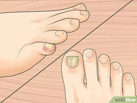 Image titled Tell if You Have an Ingrown Toenail Step 4