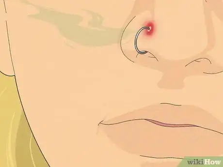 Image titled Treat an Infected Nose Piercing Step 15