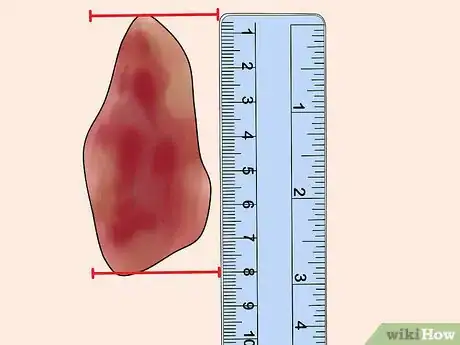 Image titled Measure Wounds Step 3