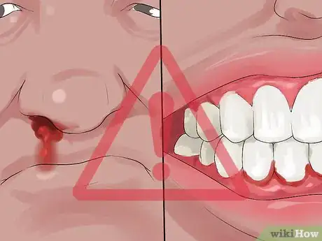 Image titled Diagnose Polycythemia Vera Step 5