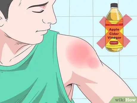 Image titled Treat Apple Cider Vinegar Burns Step 12