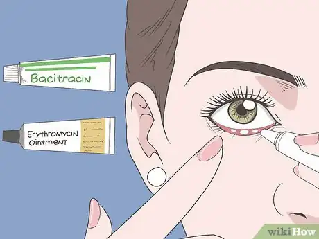 Image titled Treat Blepharitis Step 2