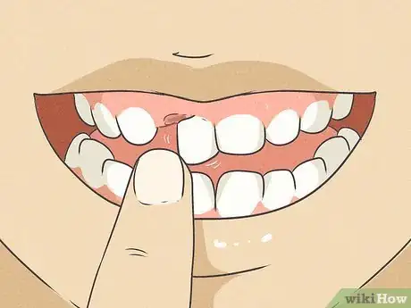 Image titled Pull Out a Tooth Without Pain Step 3