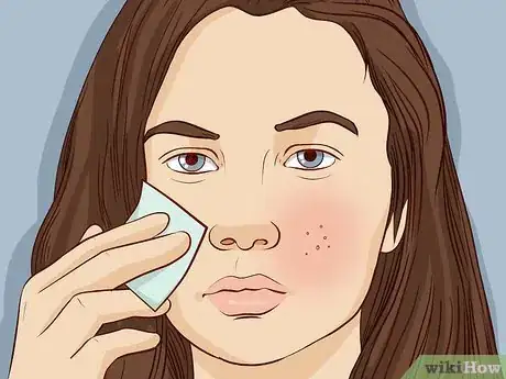 Image titled Treat Oily Skin with Large Pores Step 5