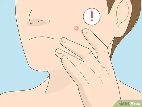 Image titled Get Rid of a Pimple Using Toothpaste Step 6