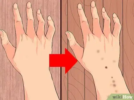 Image titled Perform Melanoma Skin Checks Step 13