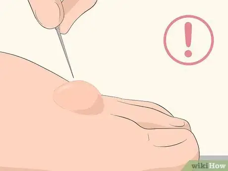 Image titled Dry Up Edema Blisters Step 4