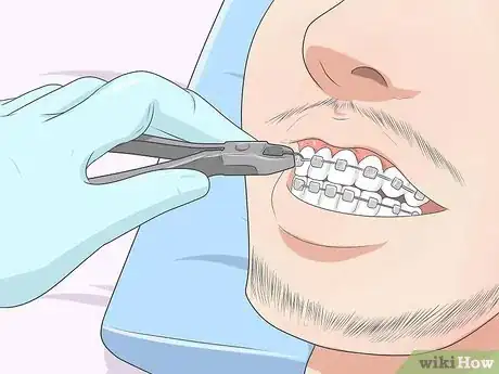 Image titled Make Your Braces Hurt Less Step 12