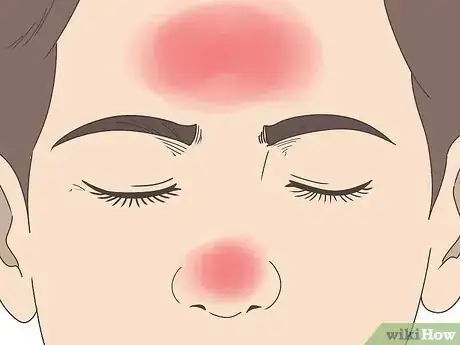 Image titled Cure Nasal Polyps Step 1