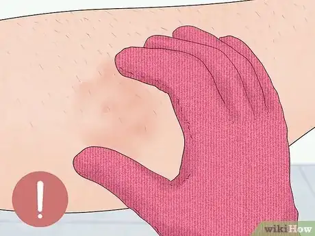 Image titled Remove an Ingrown Hair Step 5