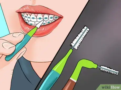 Image titled Smile With Braces Step 12