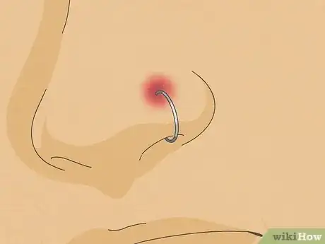 Image titled Treat an Infected Nose Piercing Step 11