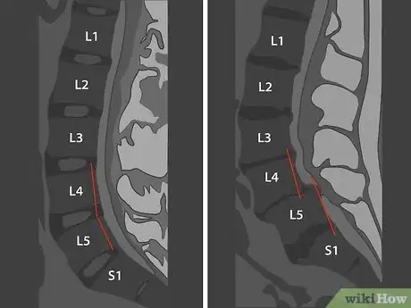 Image titled Read a Lumbar MRI Step 10