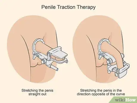 Image titled Treat Peyronie's Disease Step 11