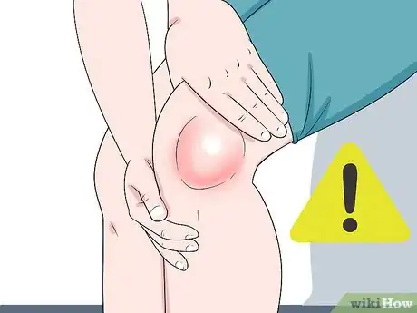 Image titled Keep Your Knees from Popping and Cracking Step 11