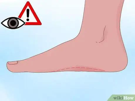 Image titled Fix Pronated Feet Step 11