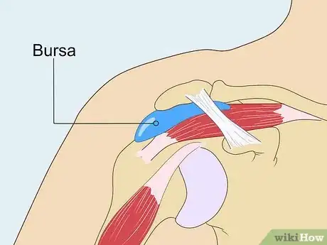 Image titled Treat Subacromial Bursitis Step 1