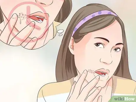 Image titled Tell if You Have a Cold Sore Step 6