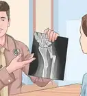 Tell if a Fall Broke Bones Without an X Ray