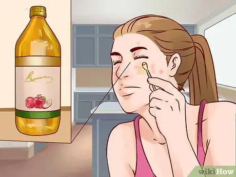 Image titled Get Rid of a Deep Pimple Step 12
