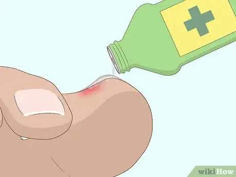 Image titled Relieve Ingrown Toe Nail Pain Step 16