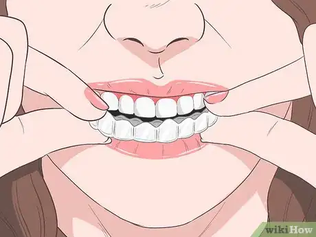 Image titled Hide Braces Step 3