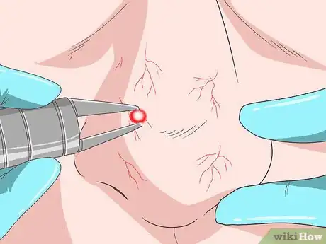 Image titled Get Rid of Spider Veins on Your Nose Step 10