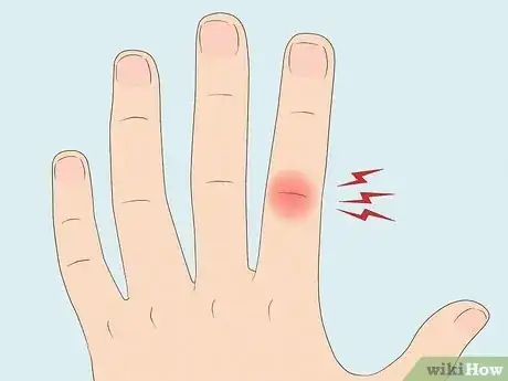 Image titled Know If Your Knuckle Is Broken Step 1