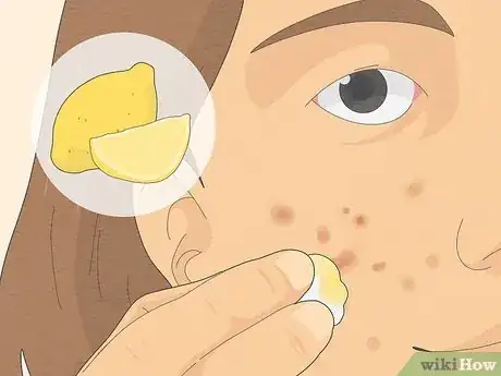 Image titled Get Rid of Cystic Acne Scars Step 2