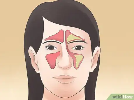 Image titled Stop Sinus Headaches Step 10