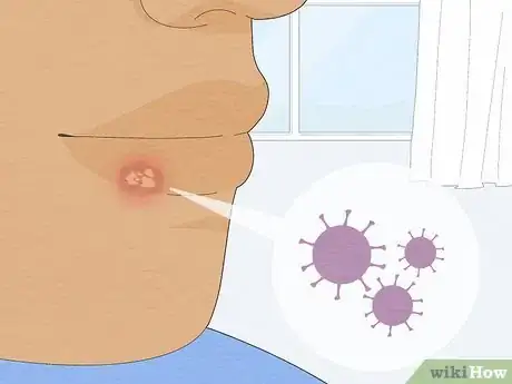 Image titled Get Rid of a Cold Sore Fast Step 18