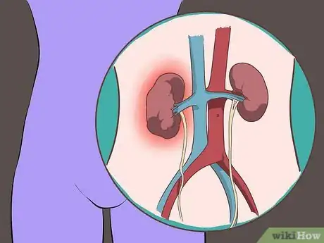 Image titled Control the Risk of Kidney Stone in Women Step 12