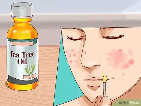 Image titled Get Rid of a Deep Pimple Step 13