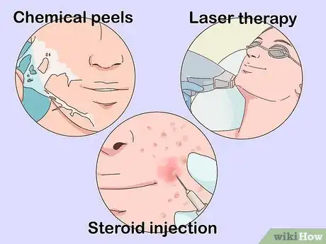 Image titled Treat Nodular Acne Step 5