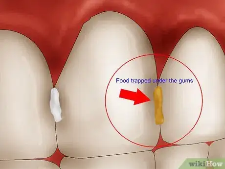 Image titled Get Rid of Gingivitis Step 2