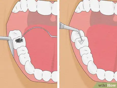 Image titled Fix Rotting Teeth Step 3