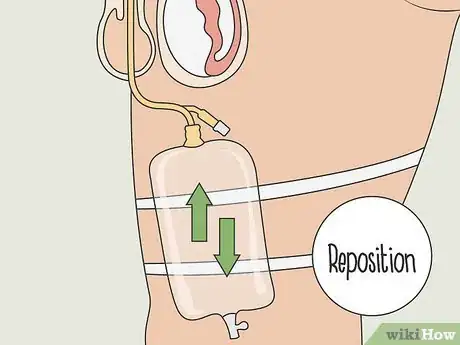 Image titled Unblock a Catheter Step 6