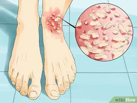 Image titled Treat Dermatitis Step 37