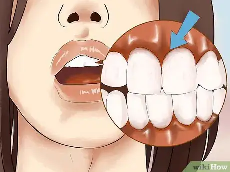 Image titled Heal Mouth Inflammation Step 10