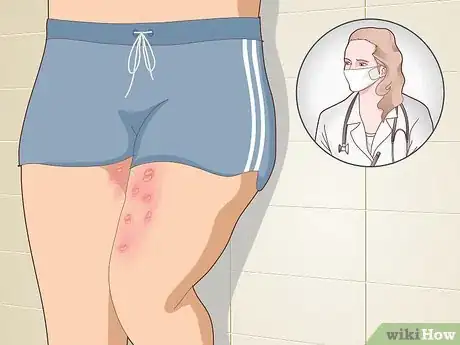 Image titled Get Rid of Poison Oak Rash Step 13