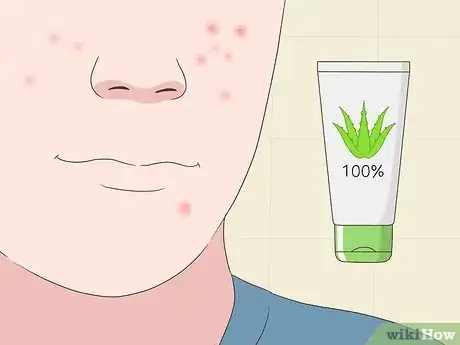 Image titled Use Aloe Vera Gel on Your Face Step 5