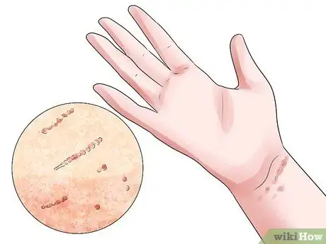 Image titled Recognize Scabies Rash Step 3