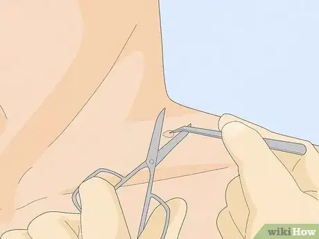 Image titled Remove a Skin Tag from Your Neck Step 2