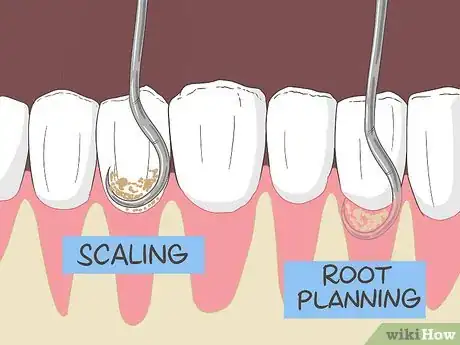 Image titled Treat an Exposed Tooth Root Step 4