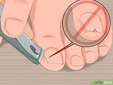 Image titled Remove Infection from an Ingrown Toenail Step 8