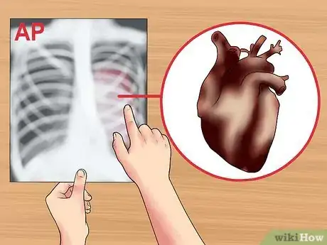 Image titled Read a Chest X Ray Step 9