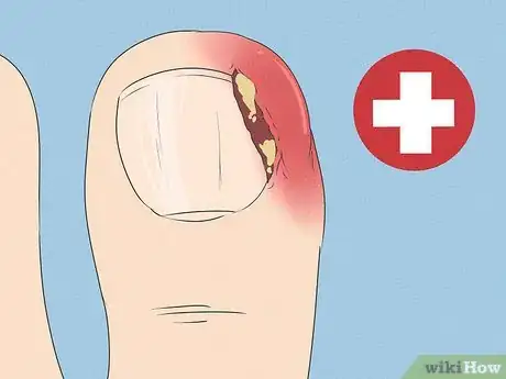 Image titled Will an Ingrown Toenail Heal Itself Step 2