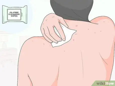 Image titled Naturally Get Rid of Back Acne Step 4